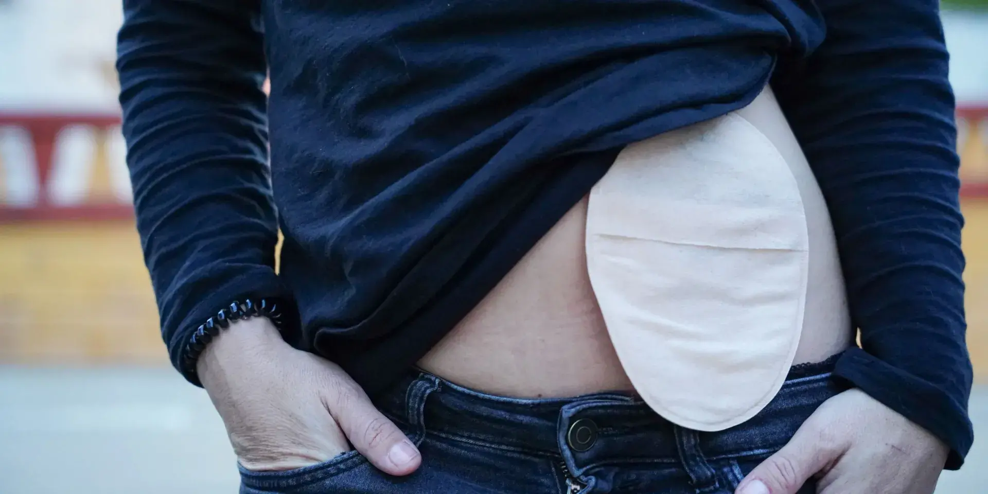 Close up image of young woman with her jumper slightly lifted to reveal her stoma bag