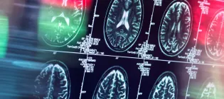 Close up of brain scans on a computer screen