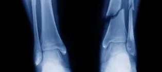 X-ray image of tibia and fibula fracture in the arm